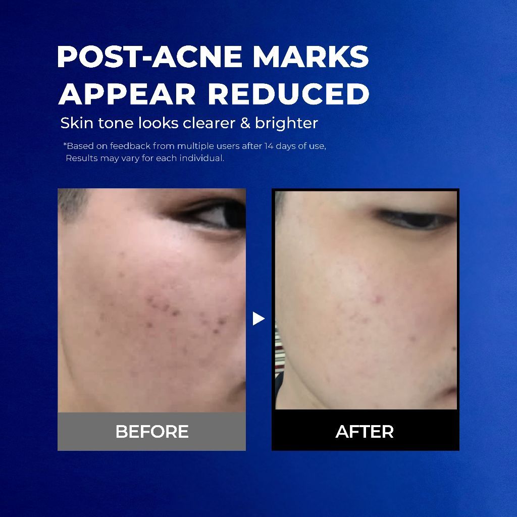 NavyX OilZero Acne Cleanser 80ml