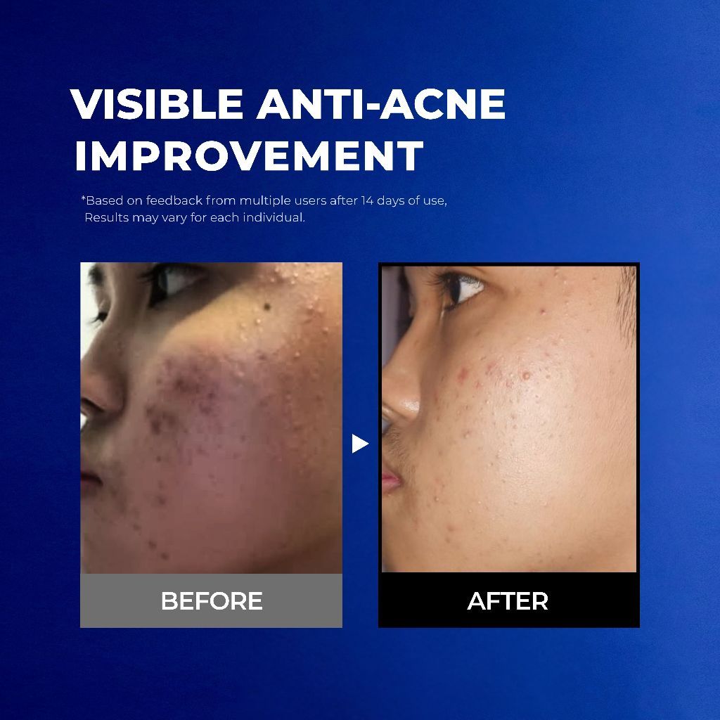NavyX OilZero Acne Cleanser 80ml